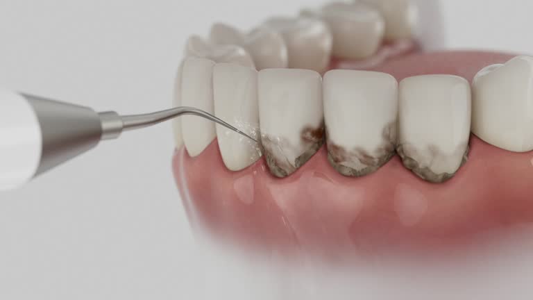 Trusted Tooth Extraction service in Sandy, UT - Dentist Open Now